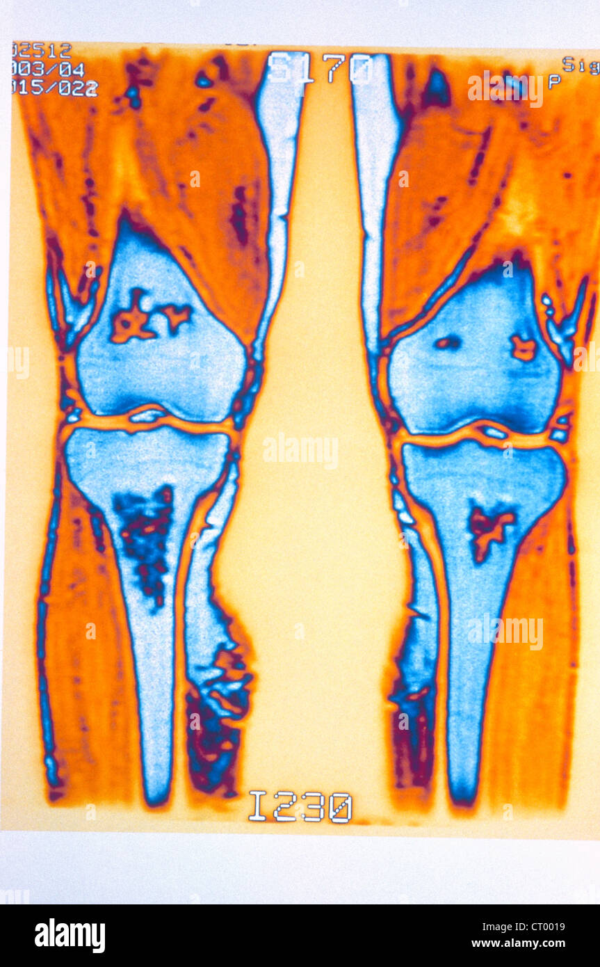 TORN MUSCLE, MRI Stock Photo