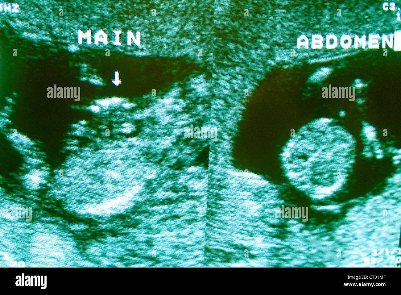 Fetal ultrasound scans hires stock photography and images Alamy