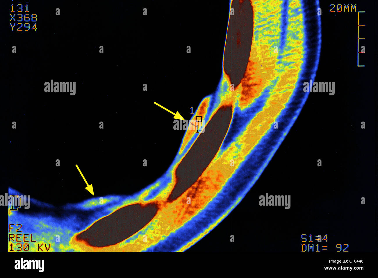 PNEUMOCONIOSIS SCANNER Stock Photo