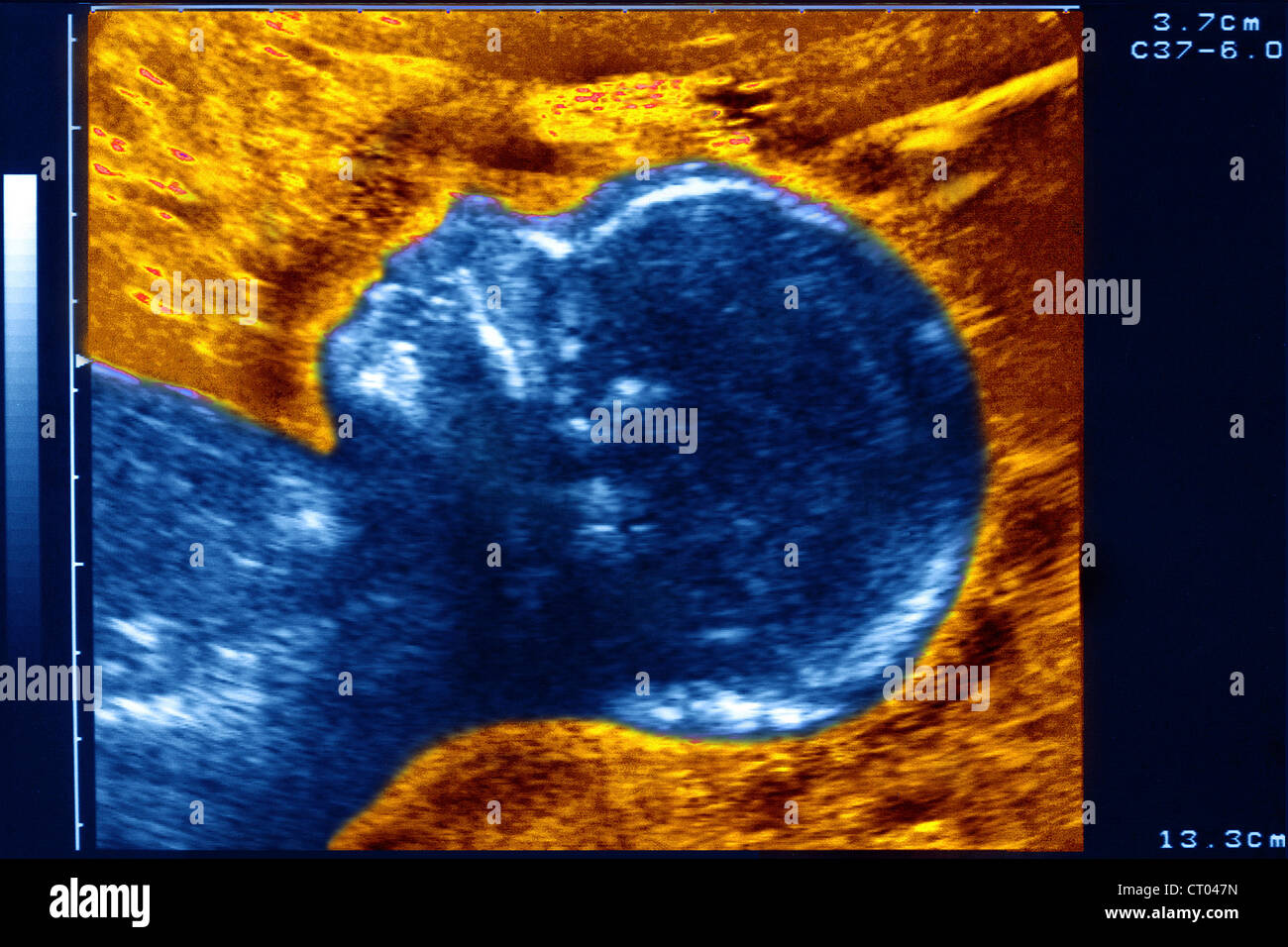 Fetal skull hires stock photography and images Alamy