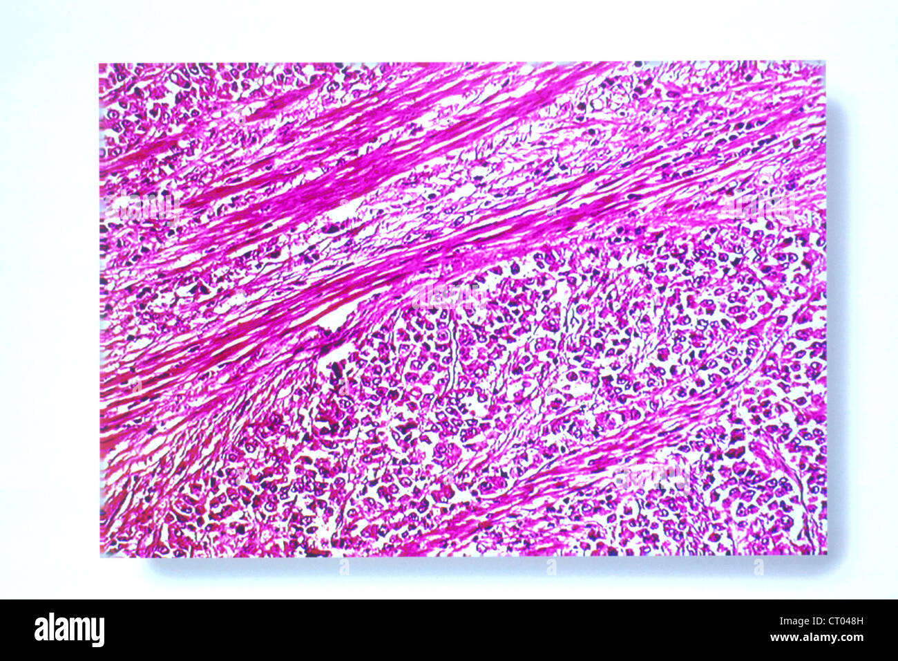 CANCER OF THE STOMACH, HISTOLOGY Stock Photo - Alamy