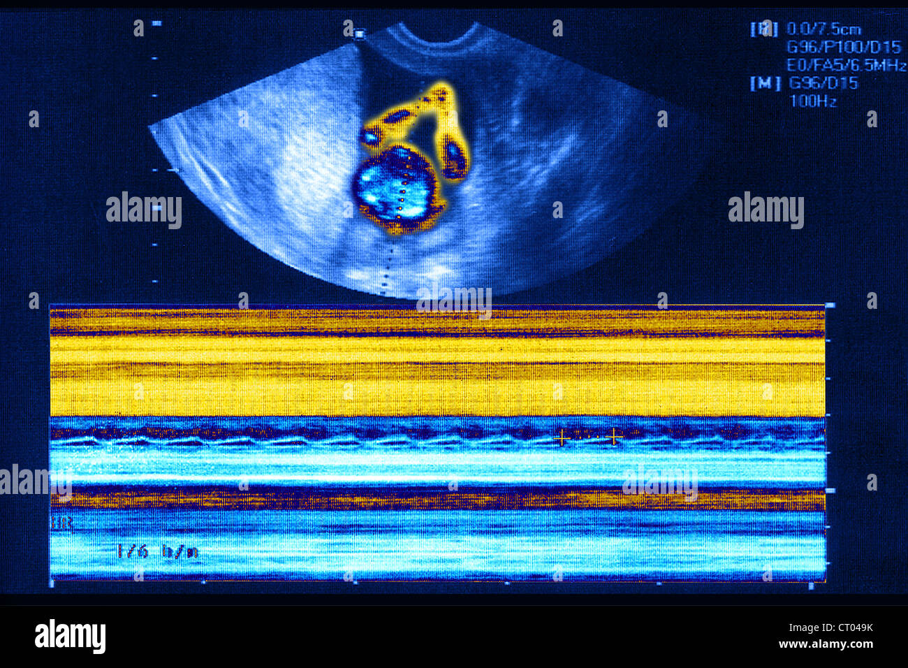3 month ultrasound hires stock photography and images Alamy