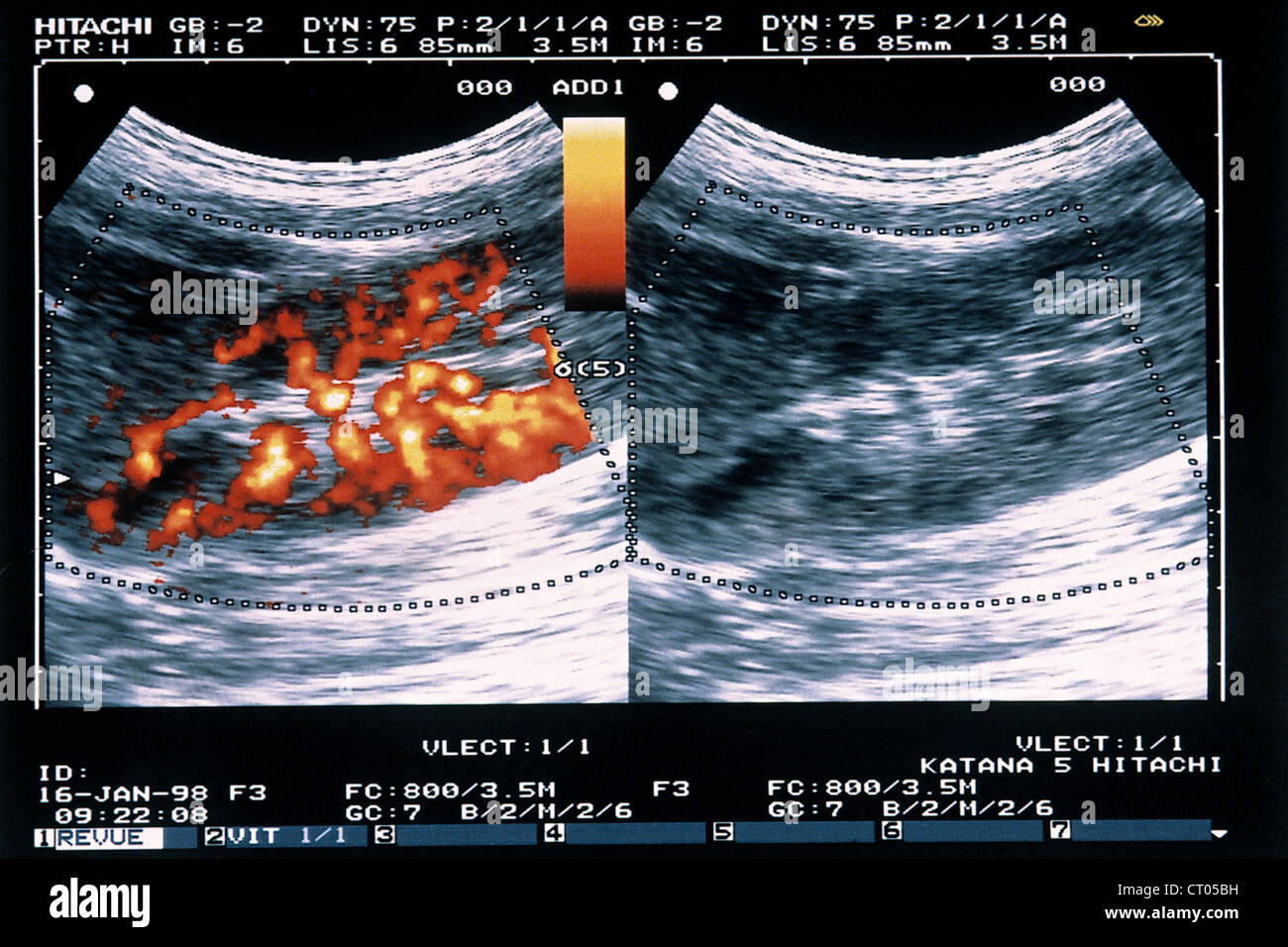 Kidney arteries scan hires stock photography and images Alamy