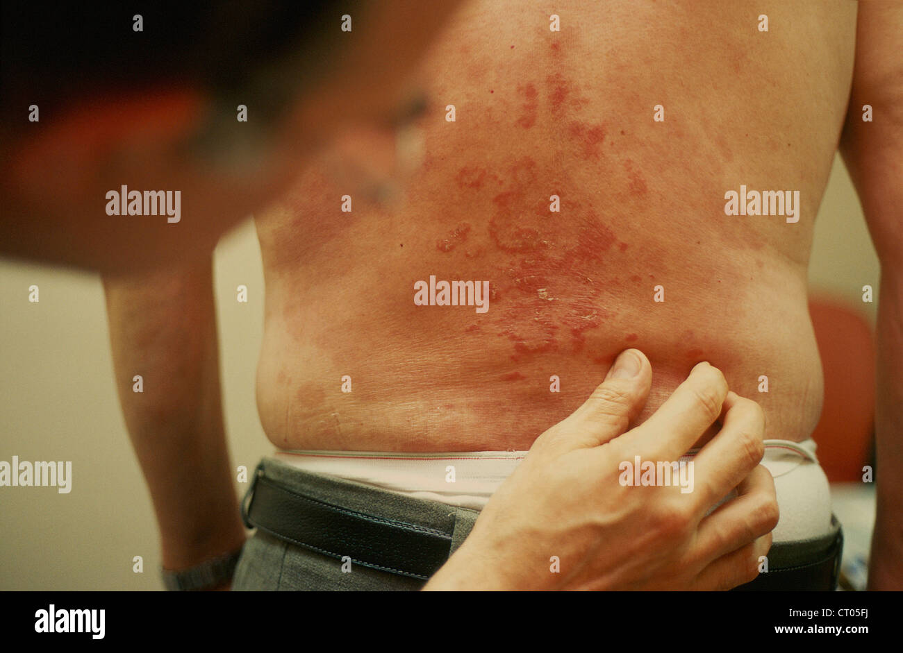 Psoriasis back hi-res stock photography and images - Alamy