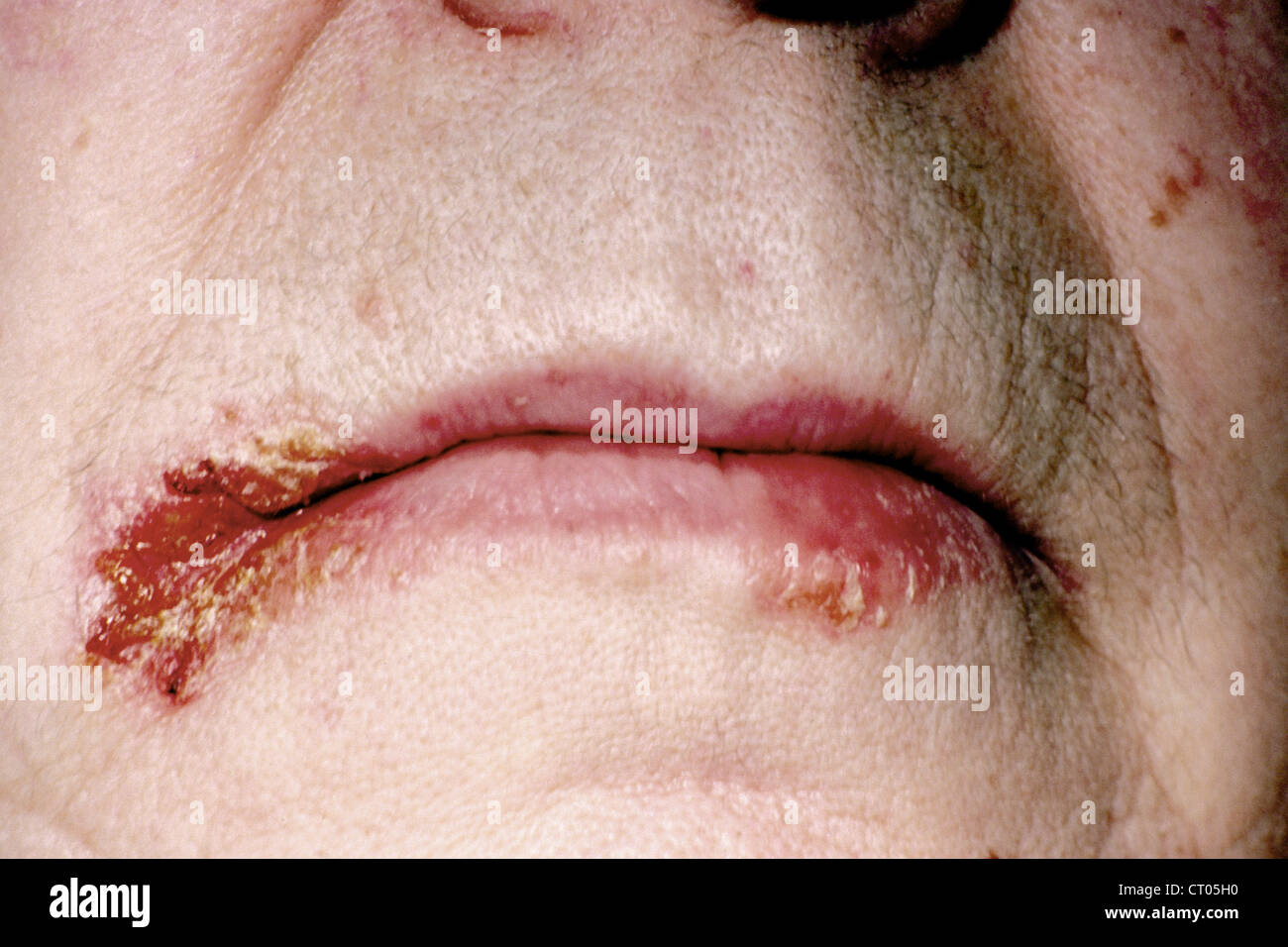 Candida albicans intertrigo - Stock Image - C038/4460 - Science Photo  Library