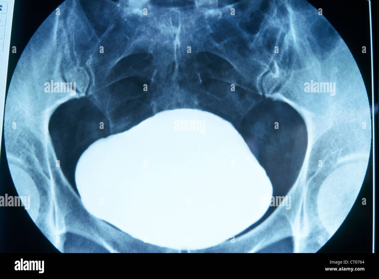 BLADDER, XRAY RESULT Stock Photo Alamy