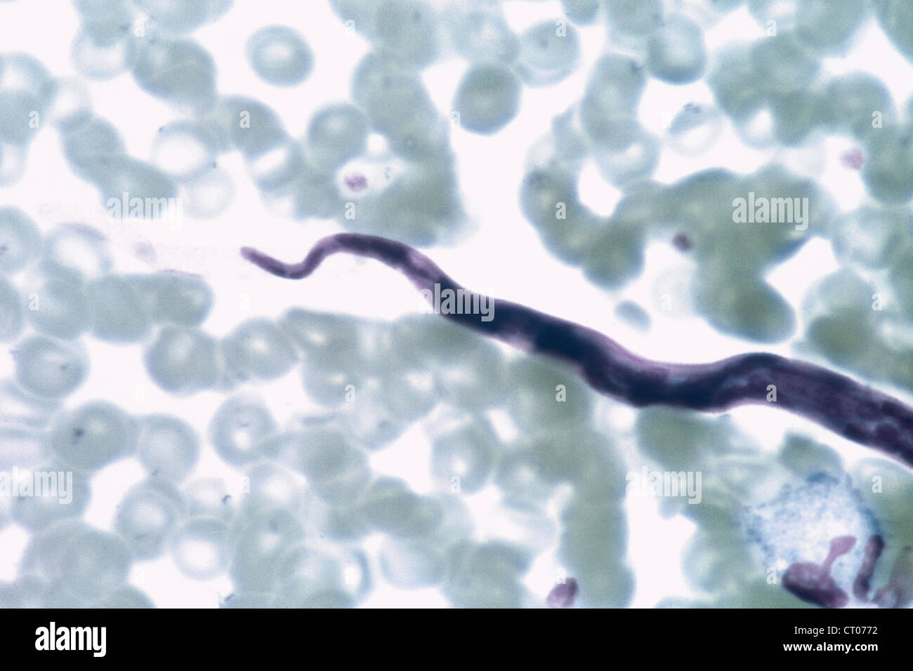 Loa loa filariasis hires stock photography and images Alamy