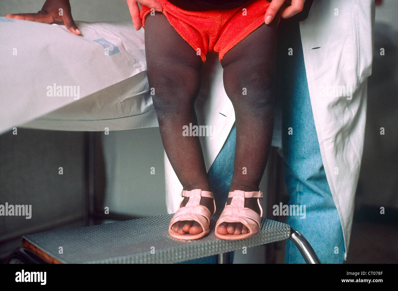 Rickets child hi-res stock photography and images - Alamy