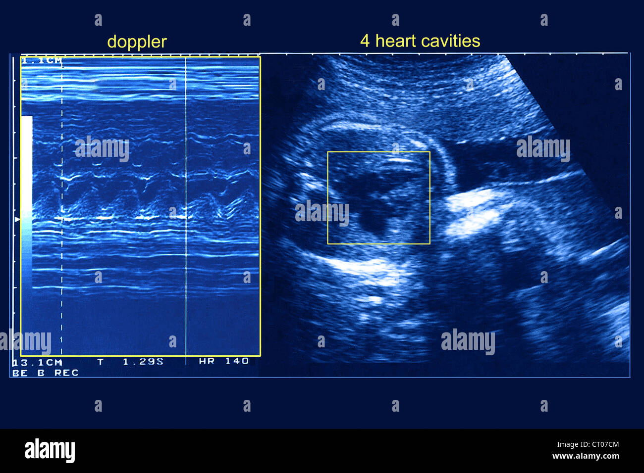 Fetus 5 months hires stock photography and images Alamy