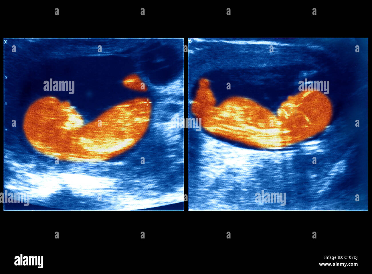 TWINS, ULTRASOUND BIOMETRY Stock Photo Alamy