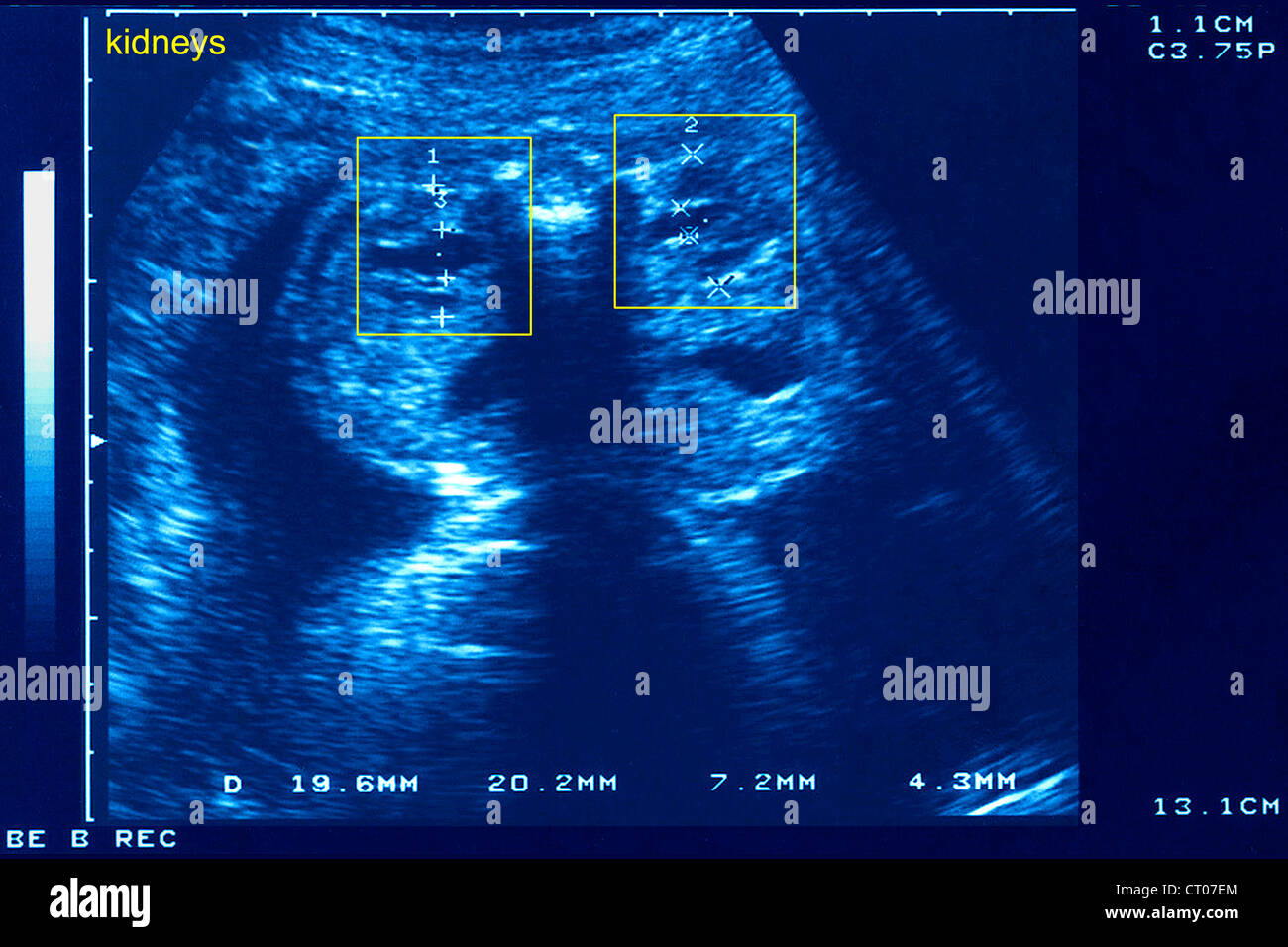 Fetus 5 months hires stock photography and images Alamy