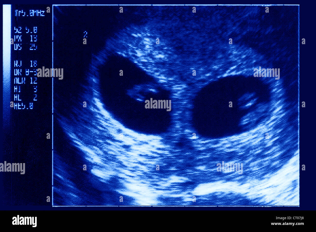 8 week ultrasound fraternal twins