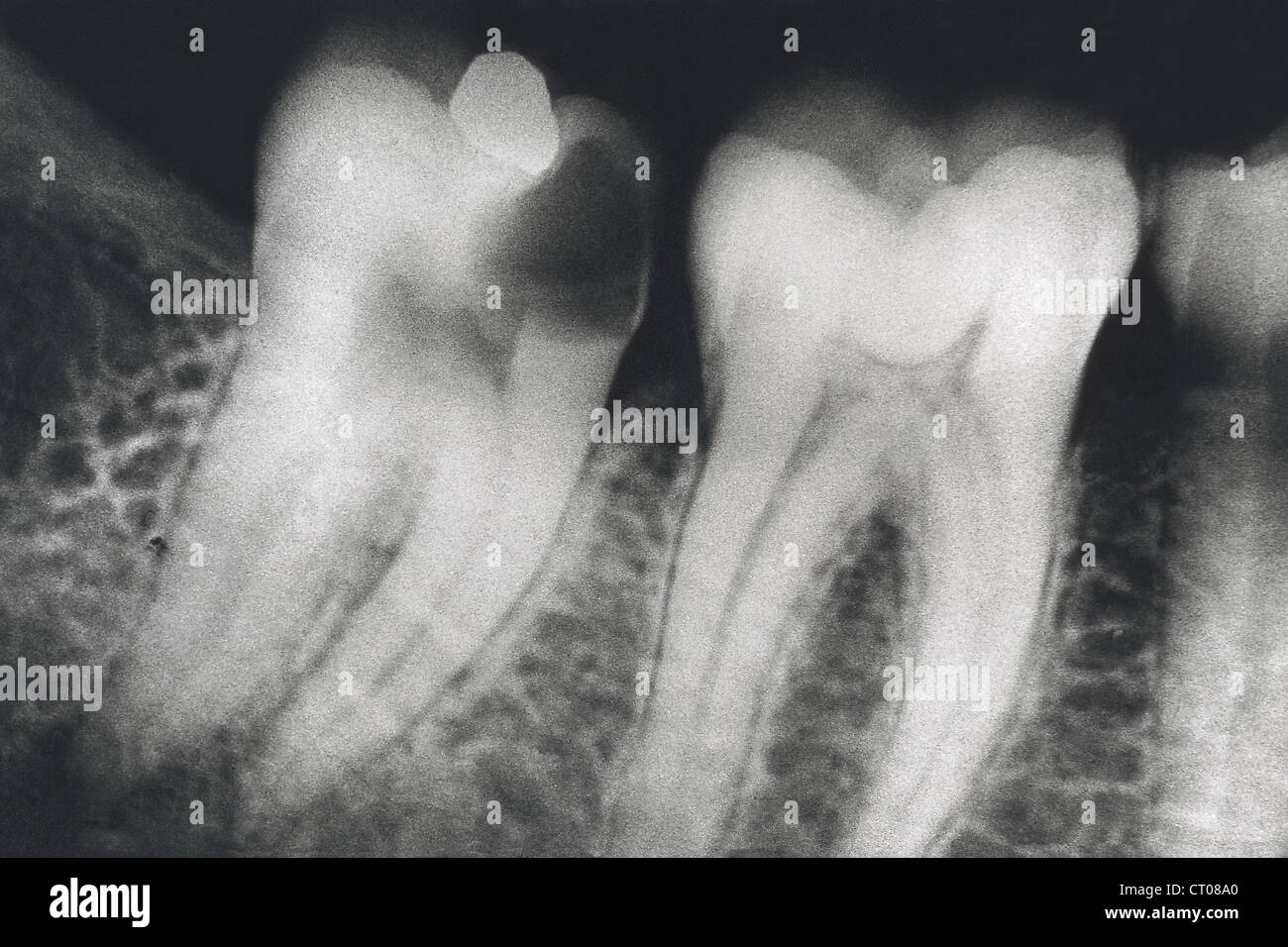 TOOTH DECAY X RAY Stock Photo 49179032 Alamy
