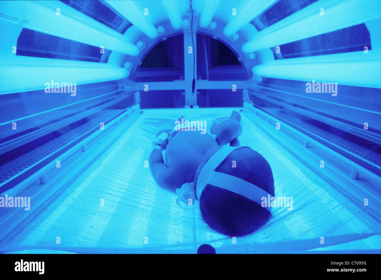 NEONATAL JAUNDICE, PHOTOTHERAPY Stock Photo  Alamy