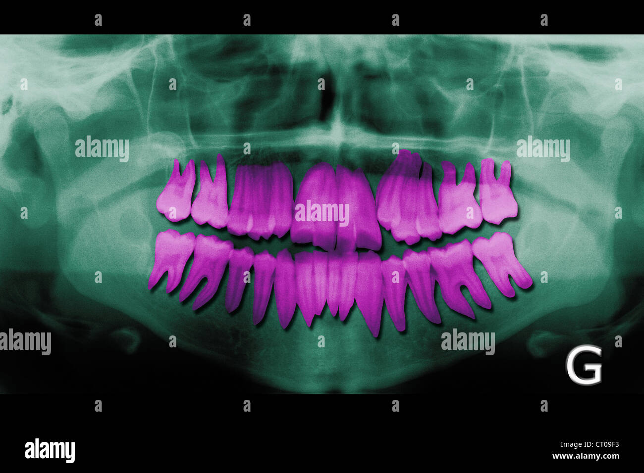 DENTAL XRAY RESULT Stock Photo Alamy