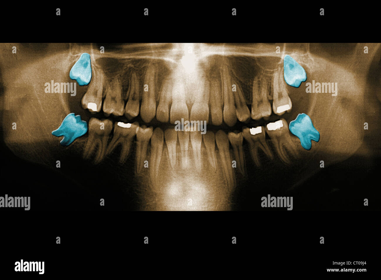 DENTAL XRAY RESULT Stock Photo Alamy
