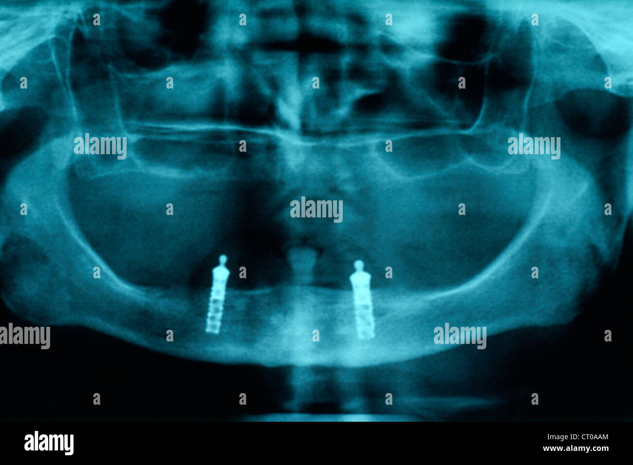 DENTAL IMPLANT, XRAY Stock Photo Alamy