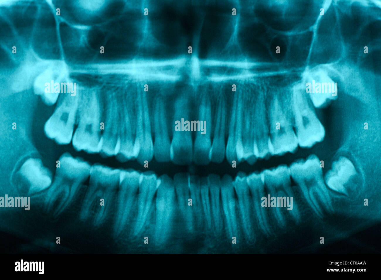 DENTAL XRAY RESULT Stock Photo Alamy