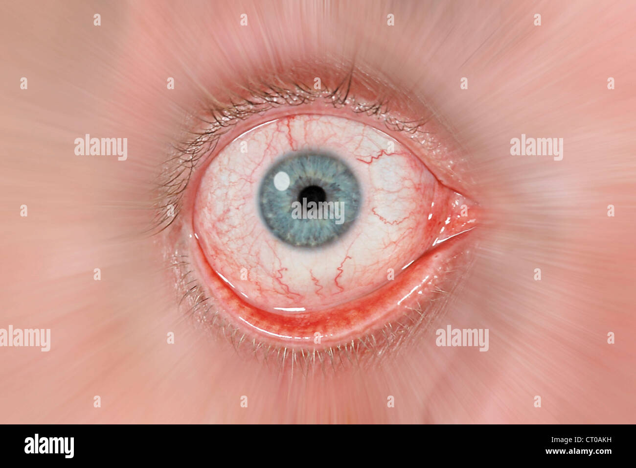 Conjunctivites hi-res stock photography and images - Alamy