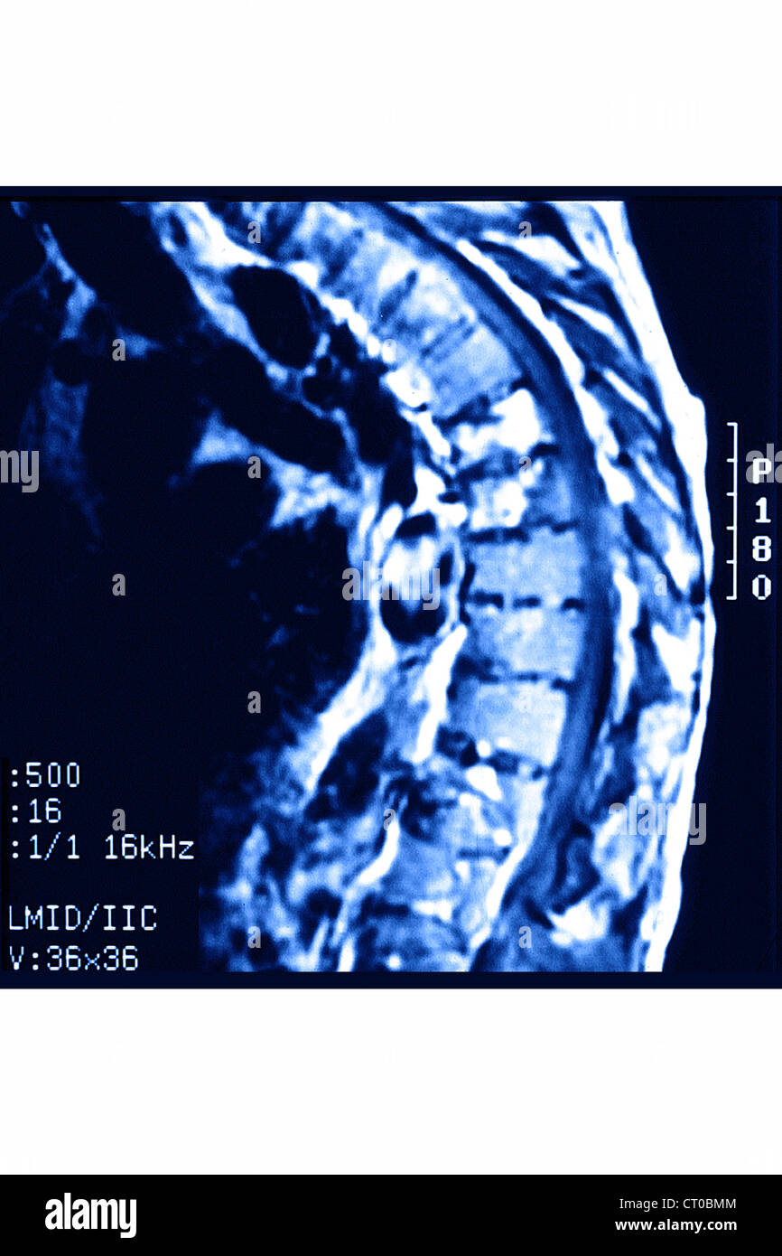 COMPRESSION FRACTURE, MRI Stock Photo Alamy