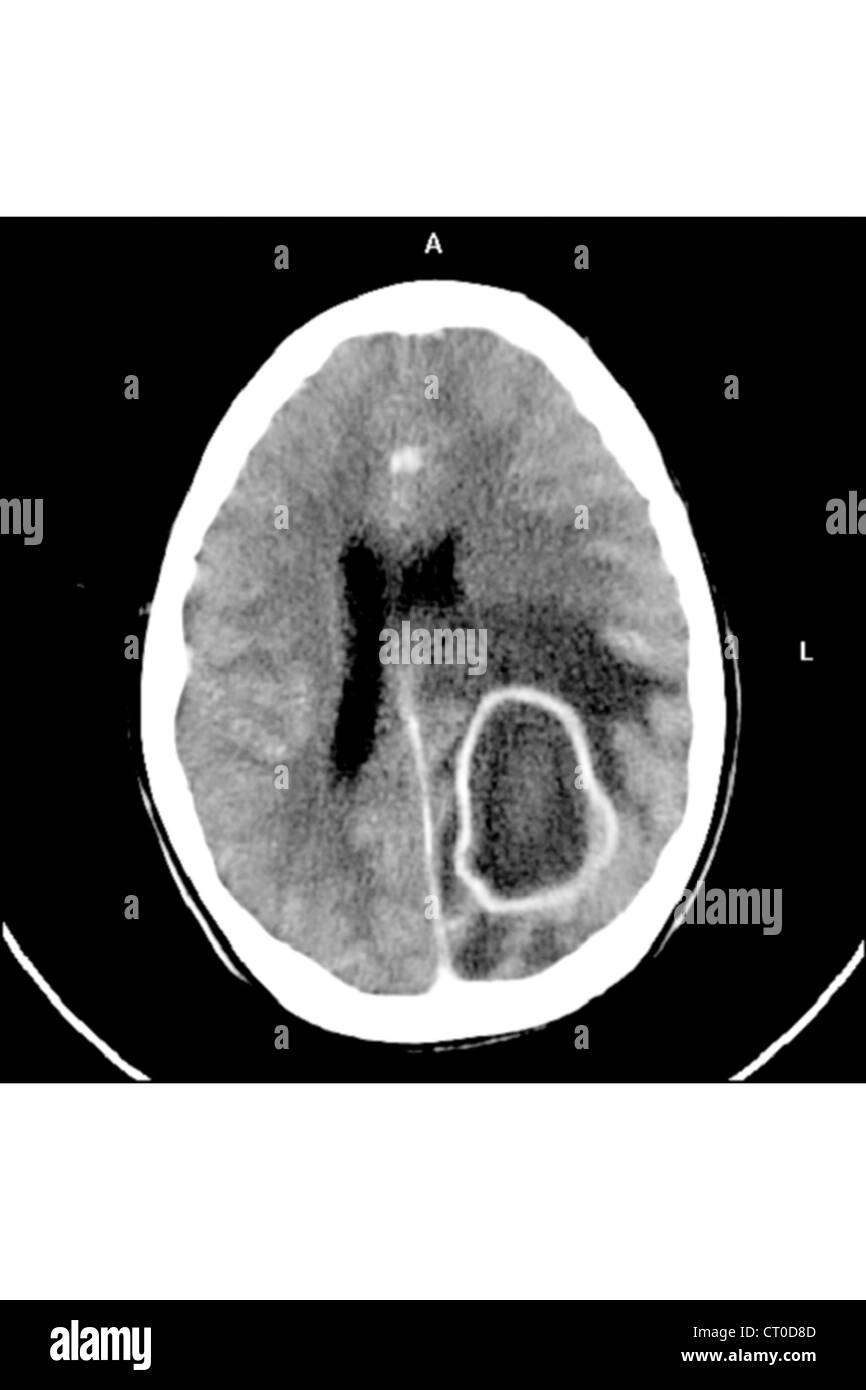 CEREBRAL ABCESS Stock Photo