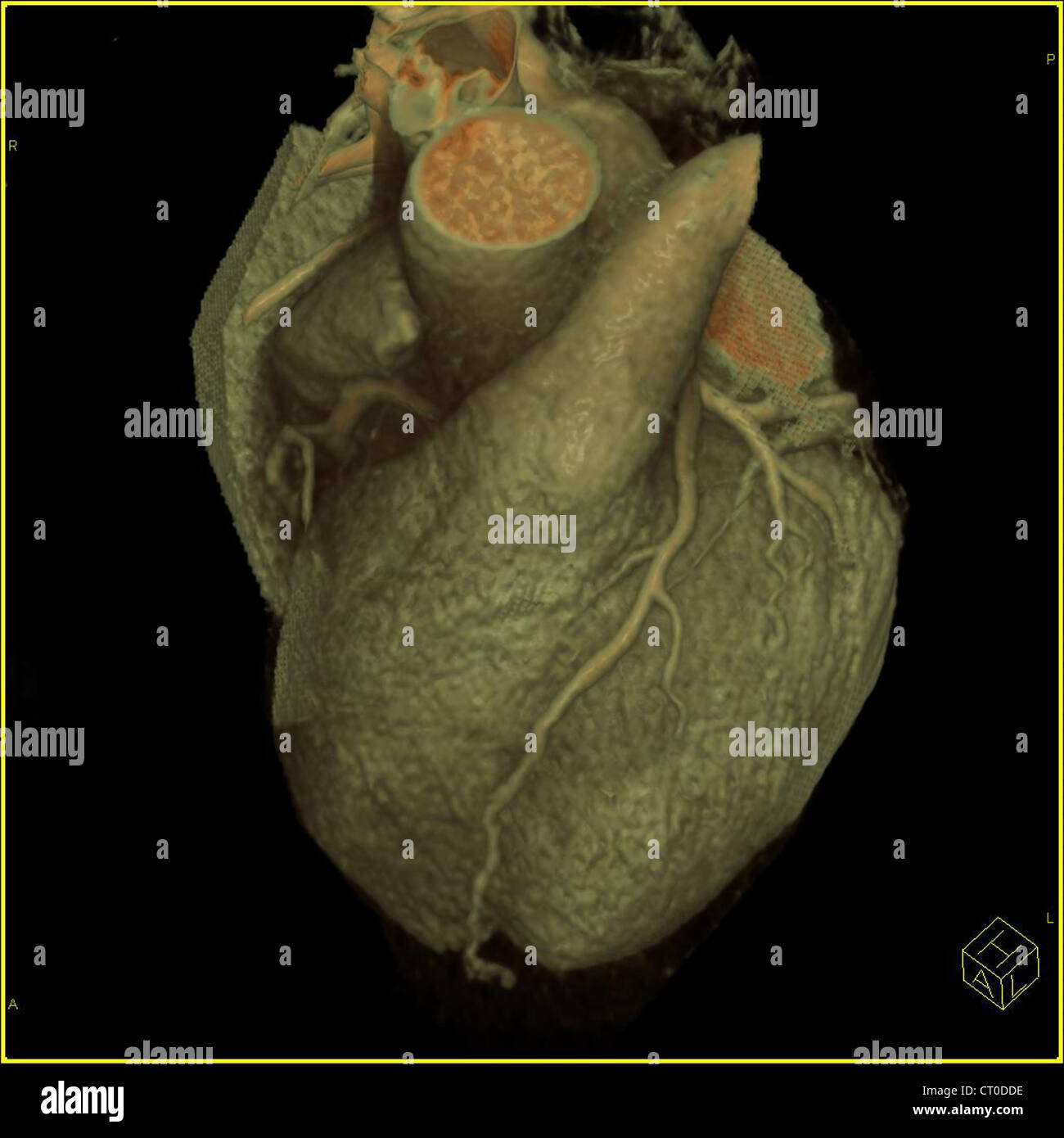 Heart blood vessels scan hi-res stock photography and images - Alamy