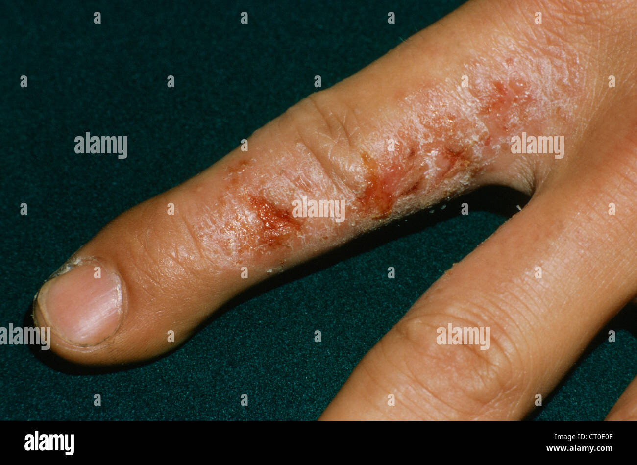 DYSHIDROSIS Stock Photo Alamy