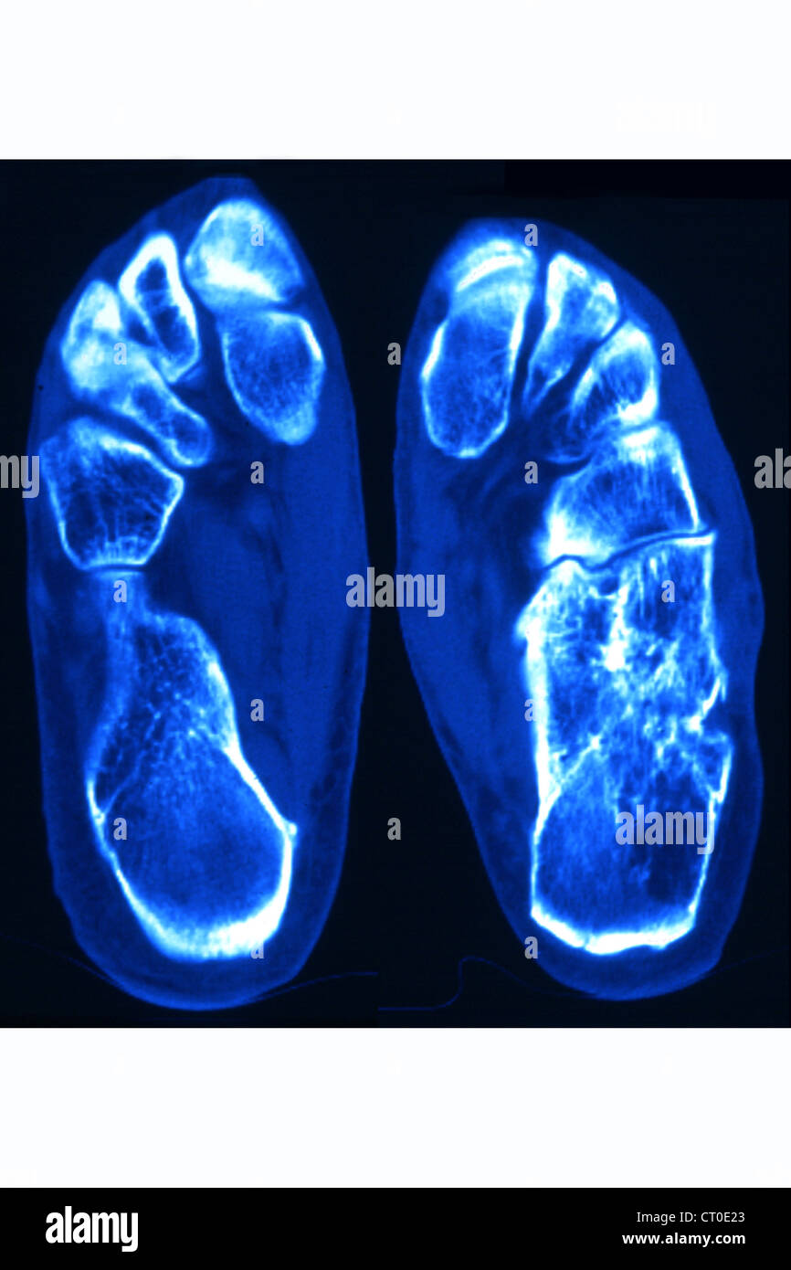 Osteoarthritis ankle x ray hires stock photography and images Alamy