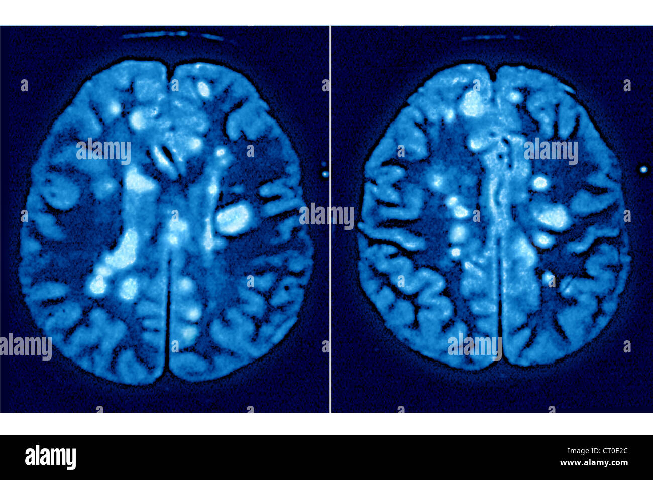Мрт мозга при рассеянном склерозе. Рассеянный склероз на мрт головного мозга. Рассеянный энцефаломиелит мрт. Демиелинизация головного мозга мрт. Мрт мозга при рассеянном склерозе.