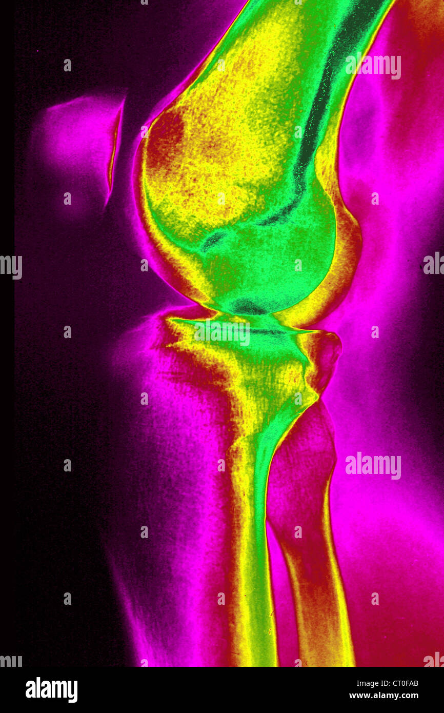 KNEE, X-RAY Stock Photo