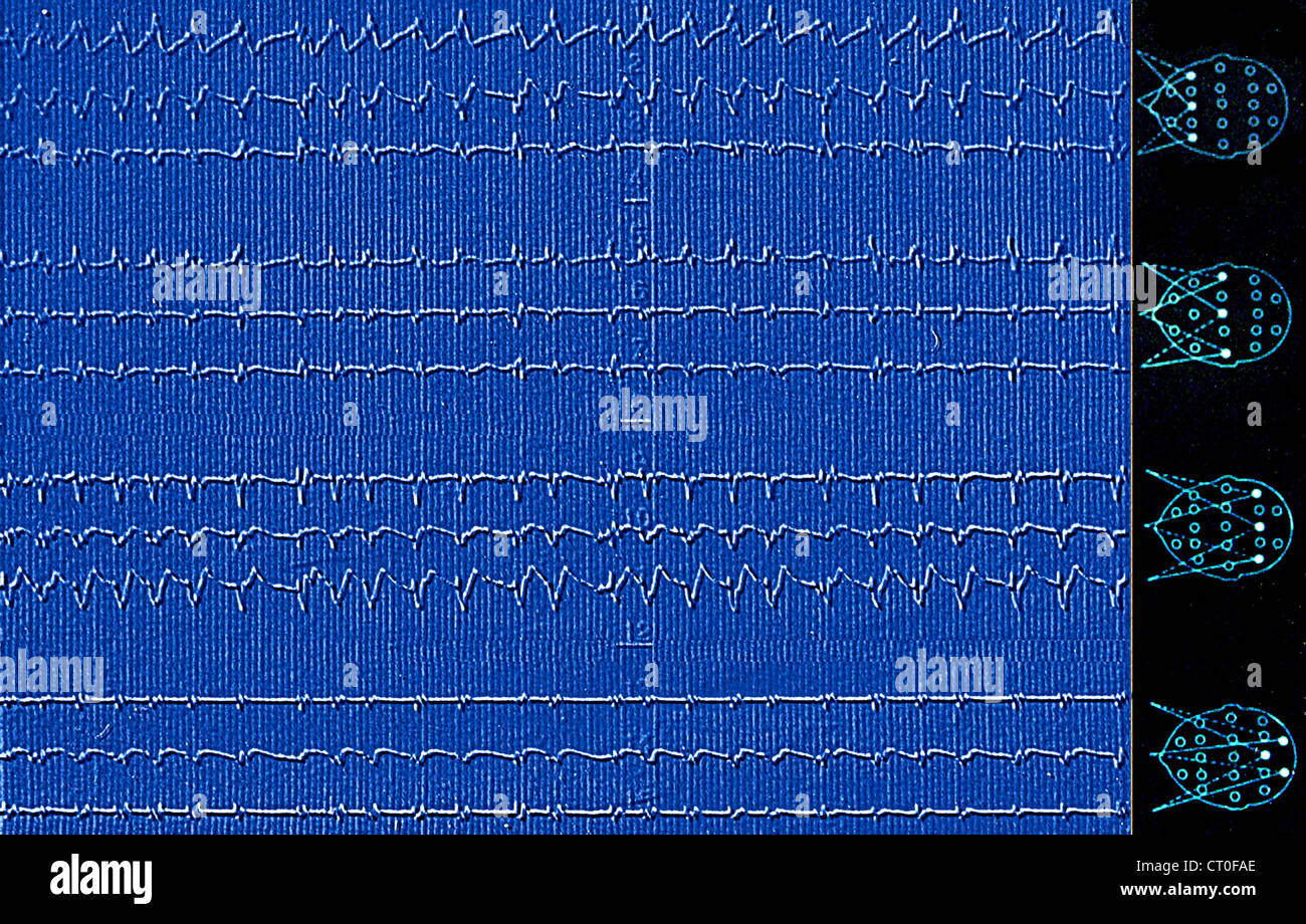 Creutzfeldt jakob disease eeg hires stock photography and images Alamy