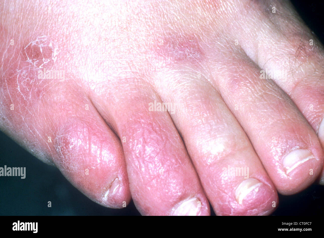 Erythema foot hires stock photography and images Alamy