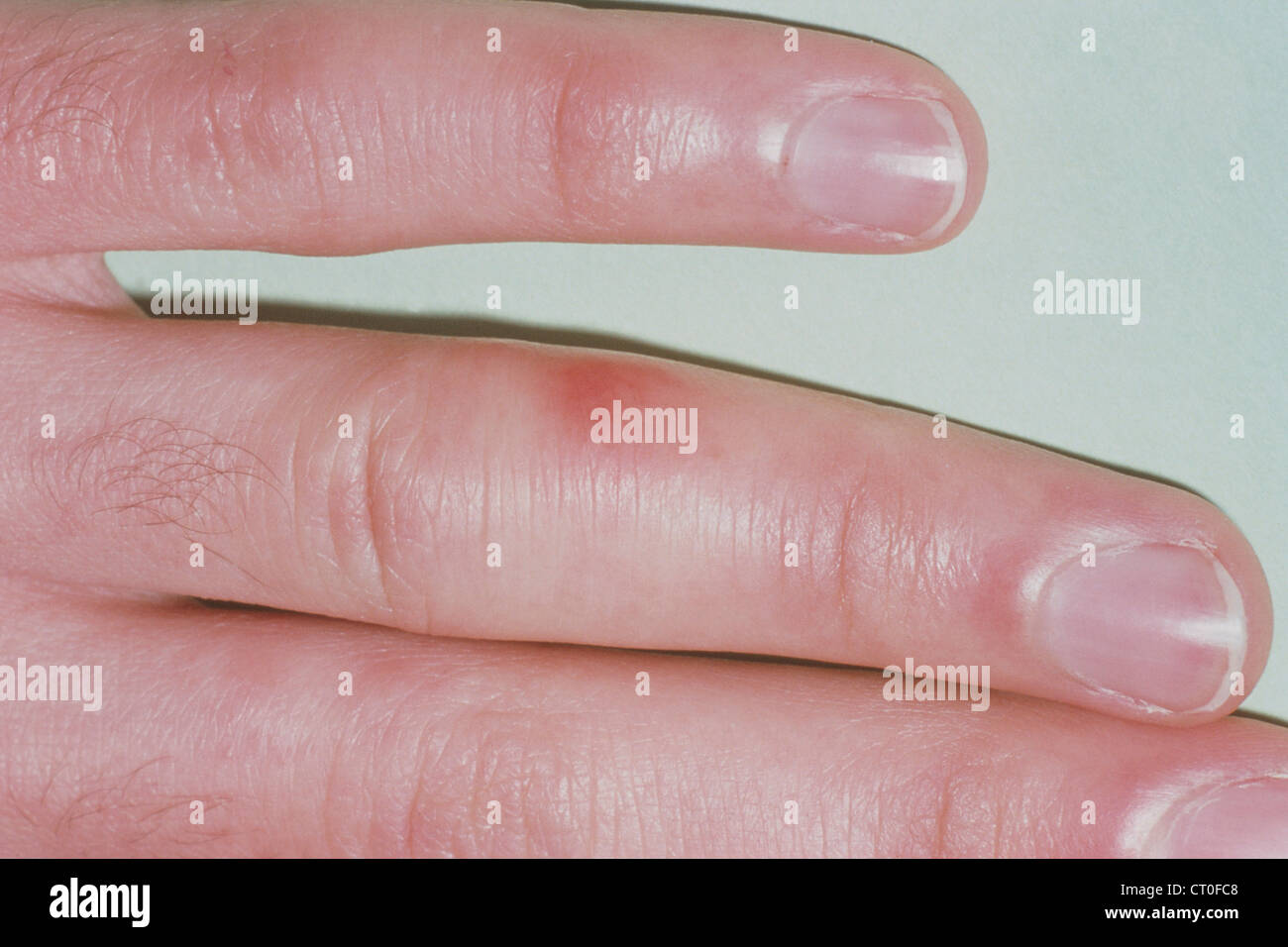 Chilblains hires stock photography and images Alamy