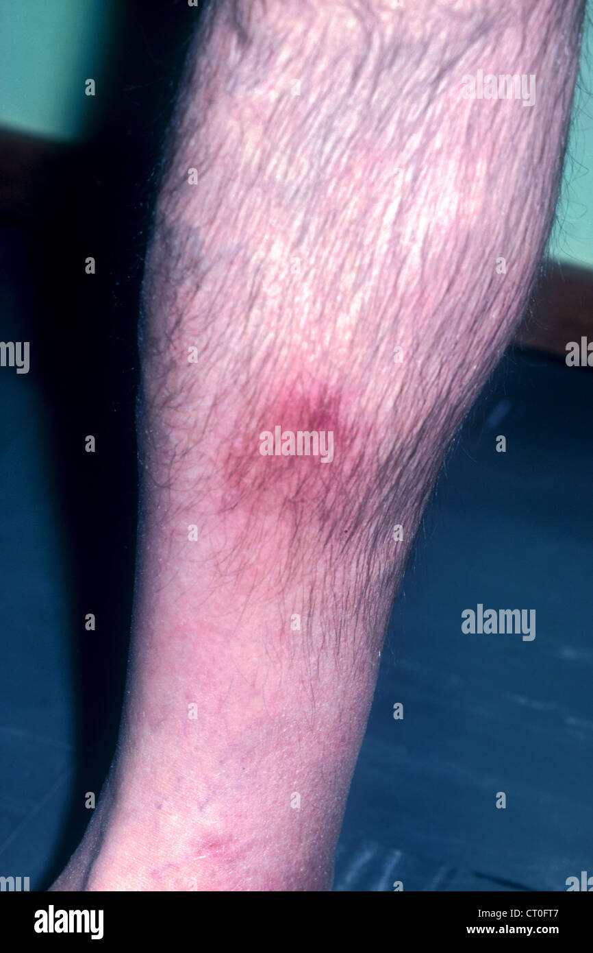 Vasculitis of legs hi-res stock photography and images - Alamy