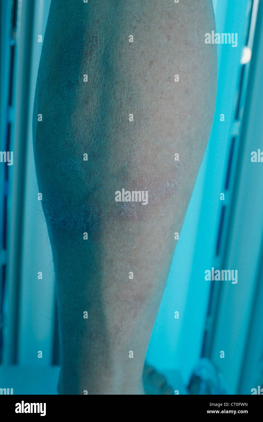 PSORIASIS, PUVA THERAPY Stock Photo Alamy