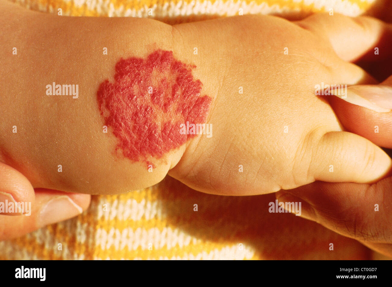 Angiomas hi-res stock photography and images - Alamy