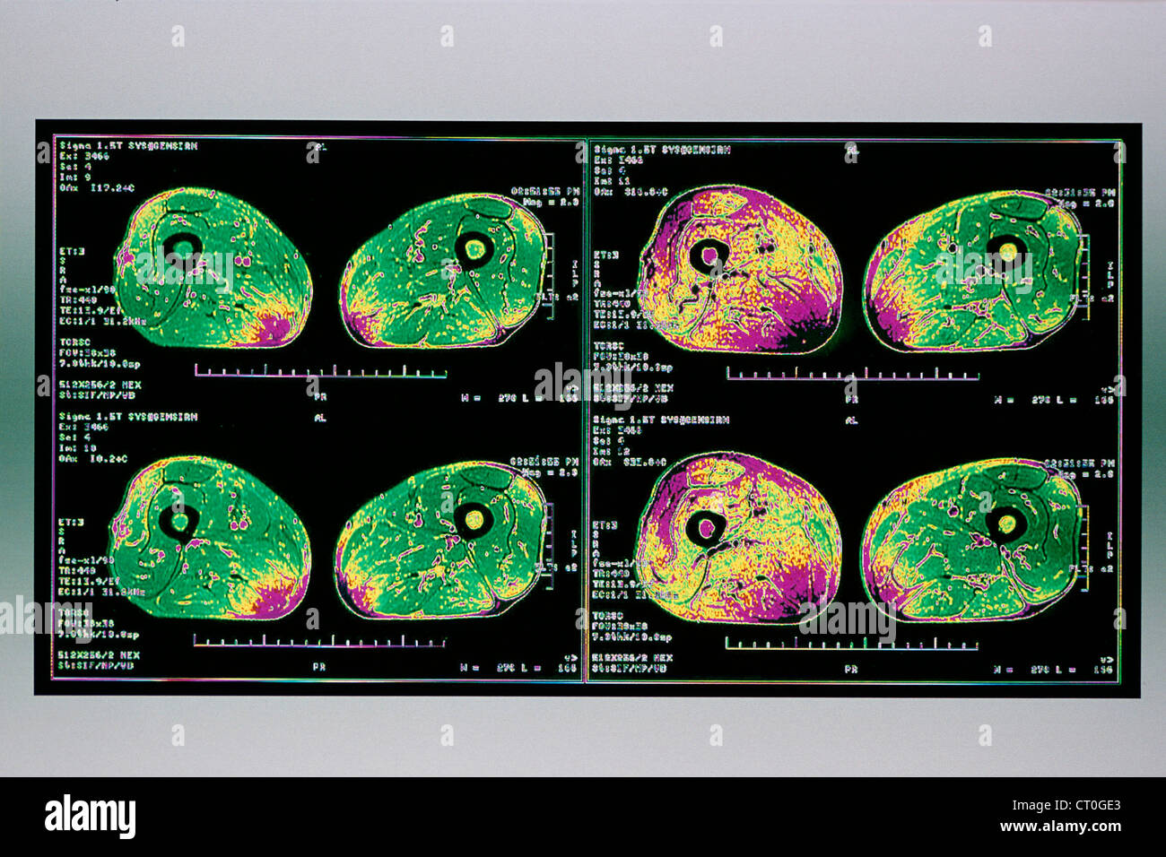 MUSCLE, MRI Stock Photo