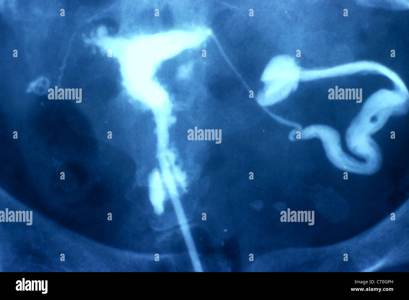 ENDOMETRIOSIS Stock Photo Alamy