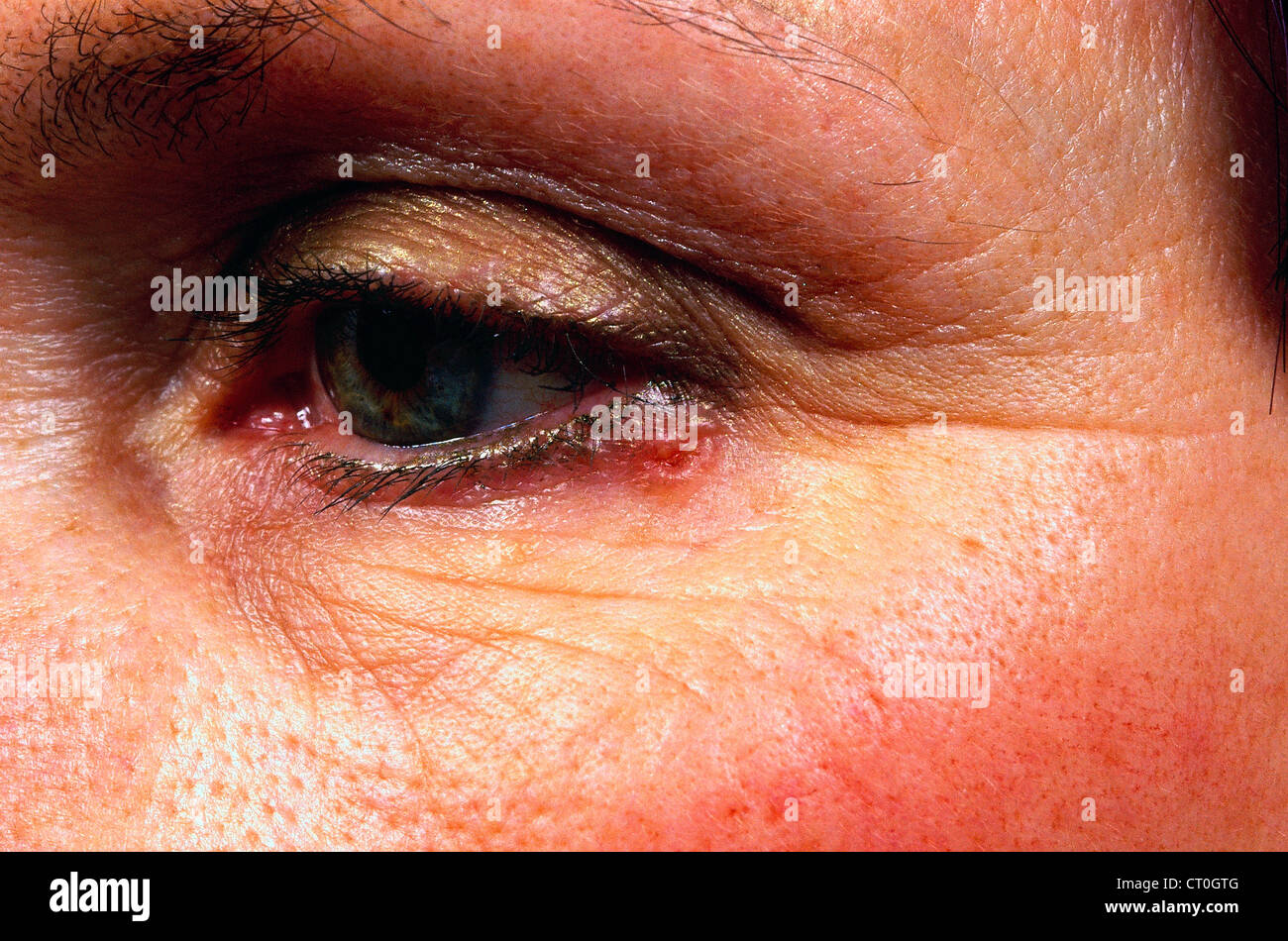 Basal cell carcinoma eyelid hires stock photography and images Alamy