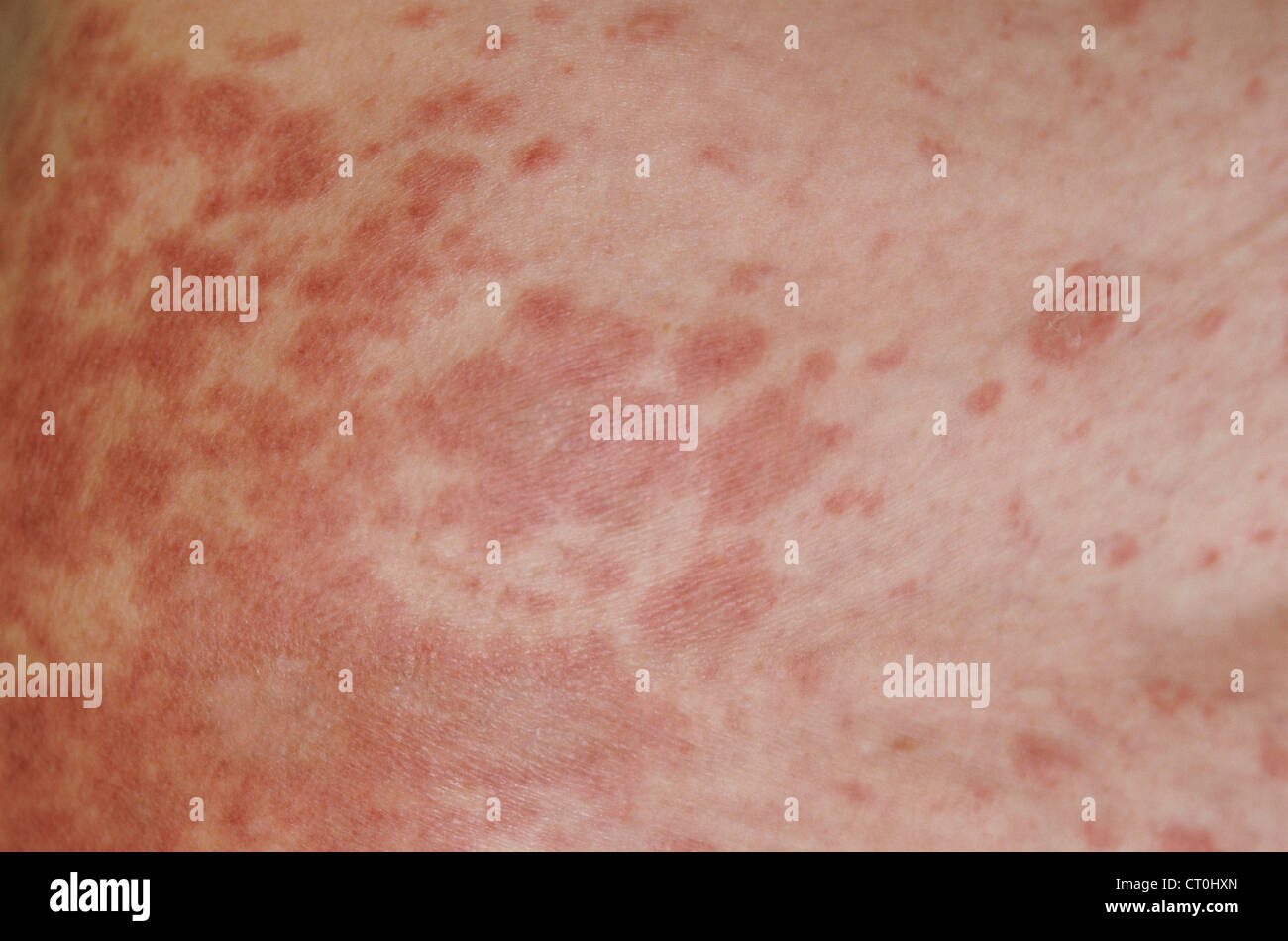 Erythema hi-res stock photography and images - Alamy