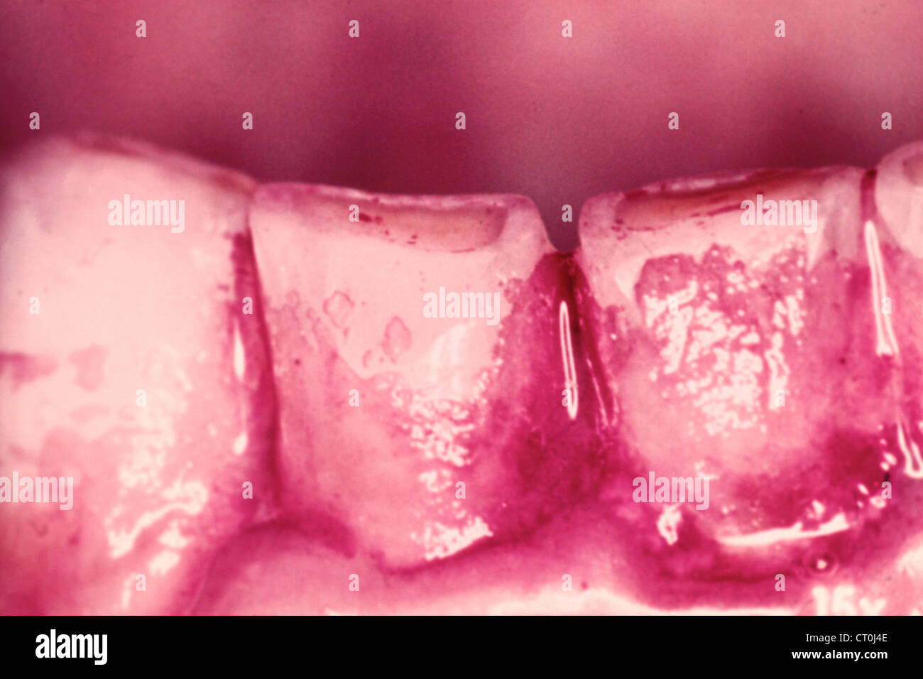 Dental Plaque High Resolution Stock Photography and Images Alamy