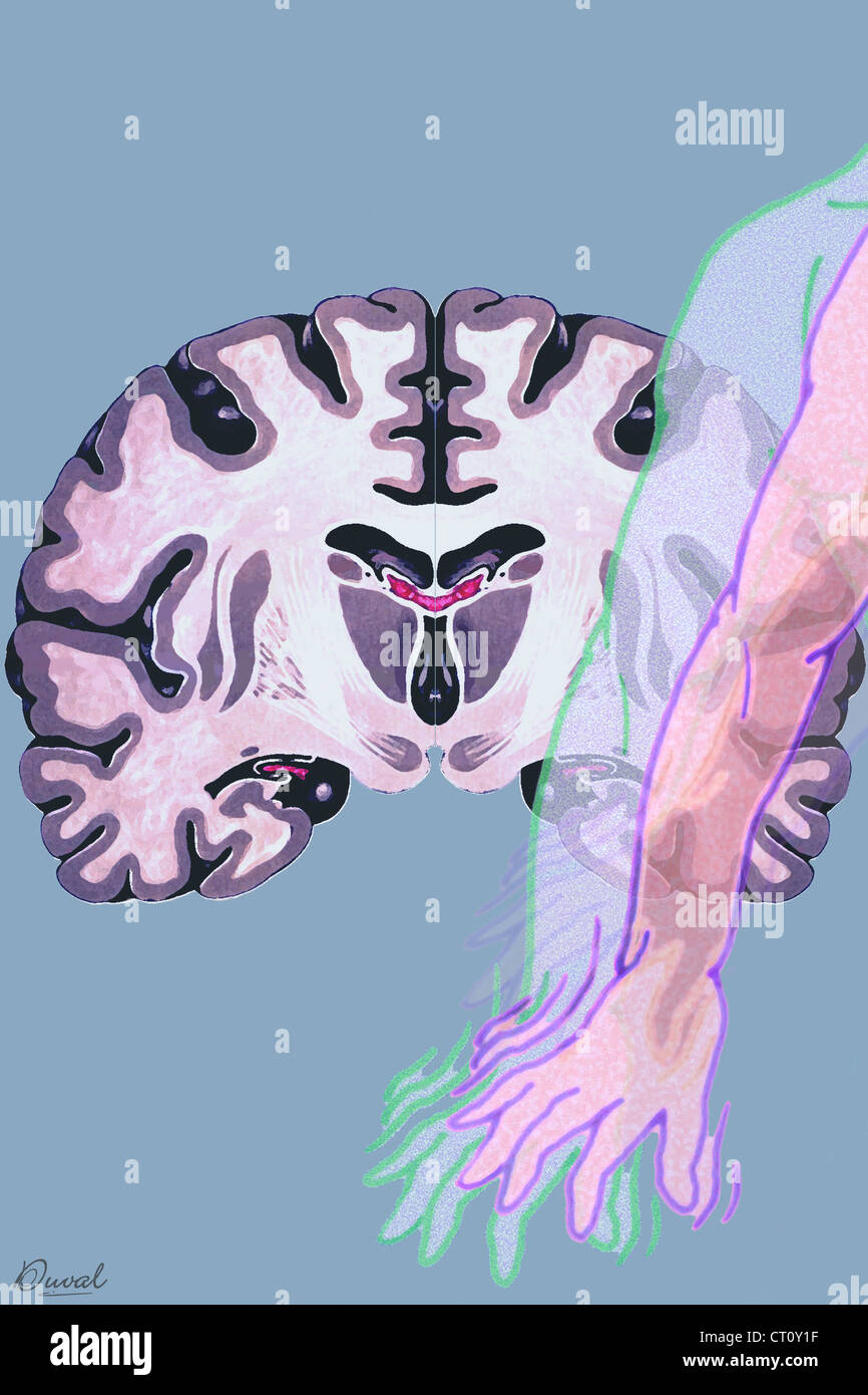 PARKINSON'S DISEASE, DRAWING Stock Photo Alamy