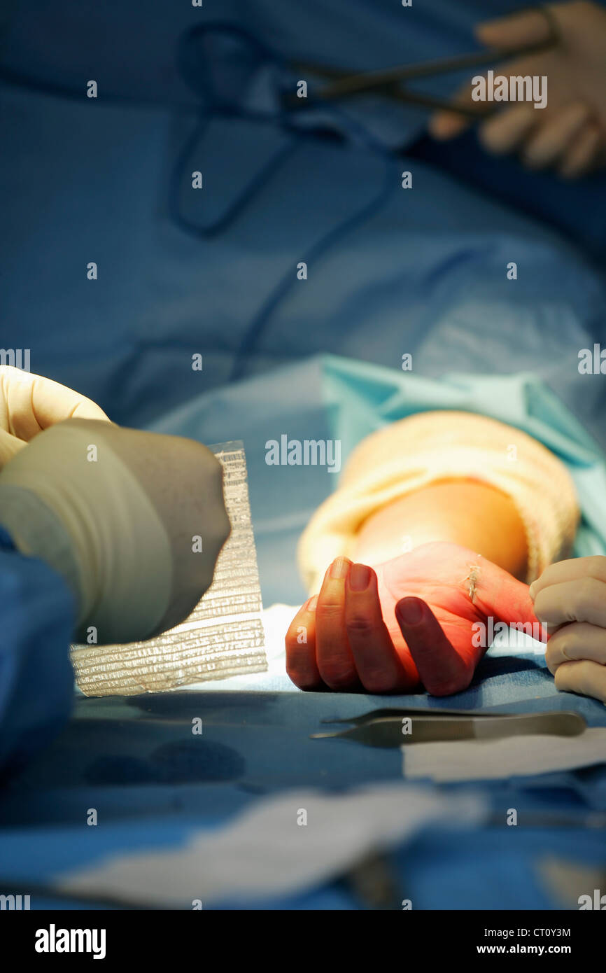 CARPAL TUNNEL, SURGERY Stock Photo - Alamy