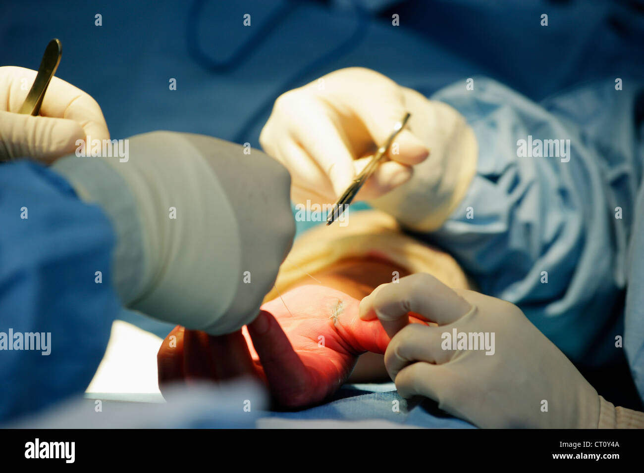 CARPAL TUNNEL, SURGERY Stock Photo - Alamy