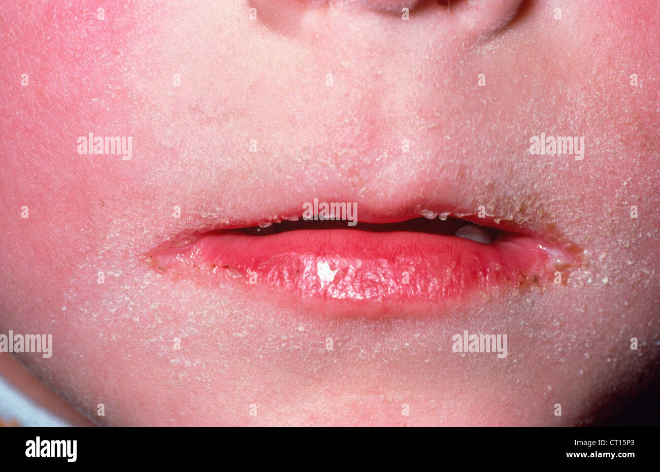 Scarlet fever mouth with symptoms of scarlatina Vector Image