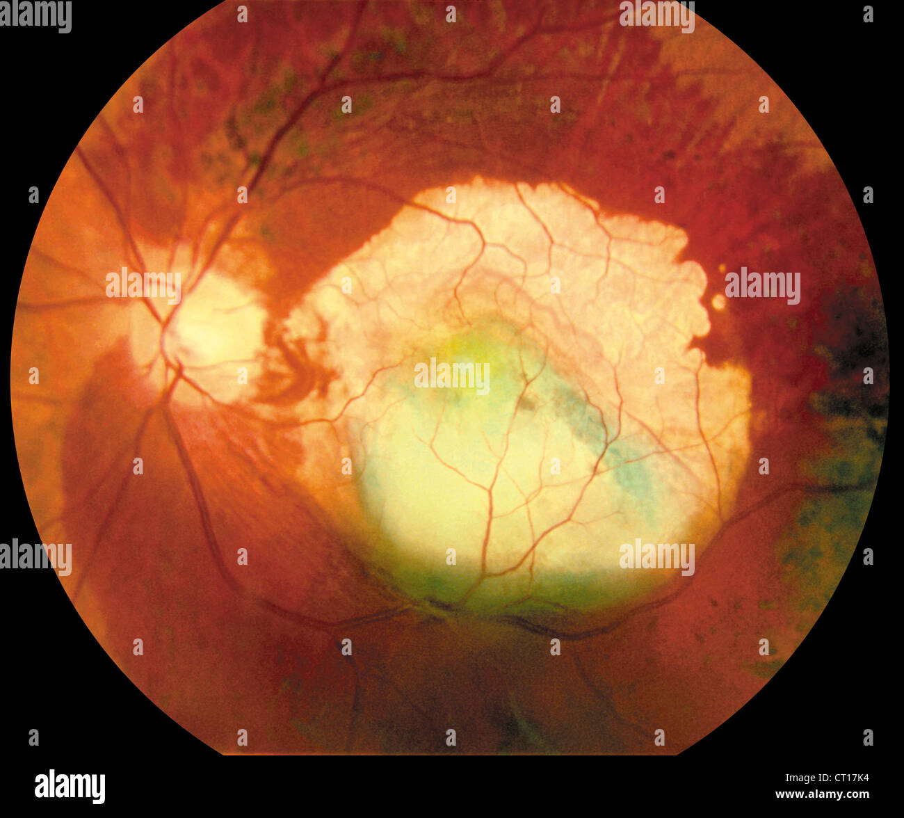 Macular Degeneration High Resolution Stock Photography and Images Alamy