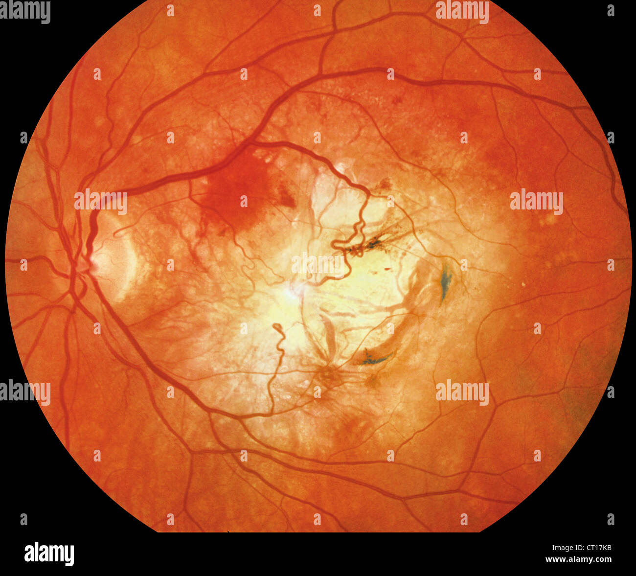 SENILE MACULAR DEGENERATION Stock Photo Alamy