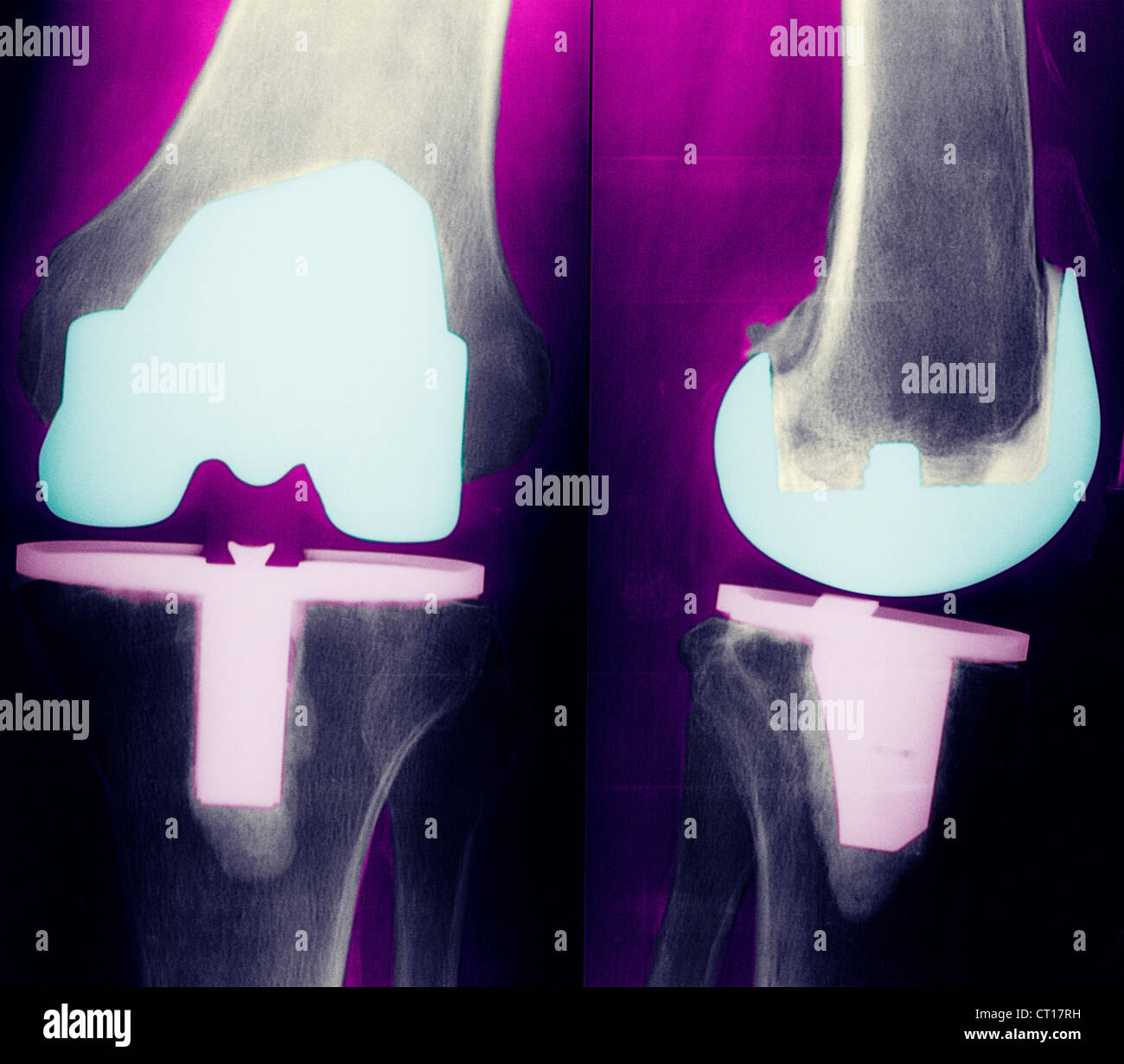 KNEE PROSTHESIS, XRAY Stock Photo Alamy