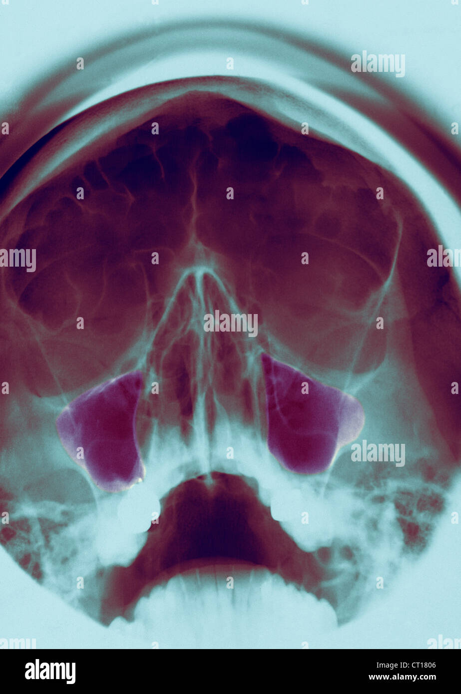 Normal Sinus X Ray
