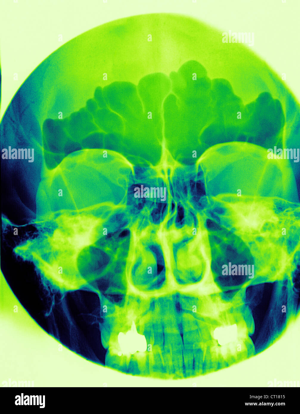 Normal x ray of sinuses hires stock photography and images Alamy